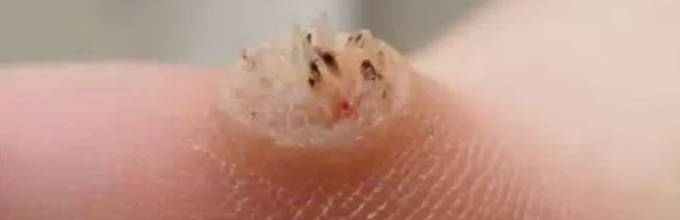 Папилломавирус