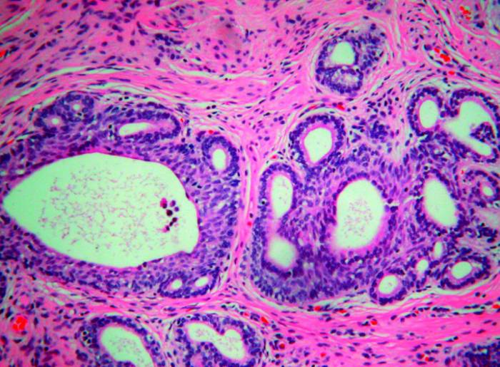 трихомониаз