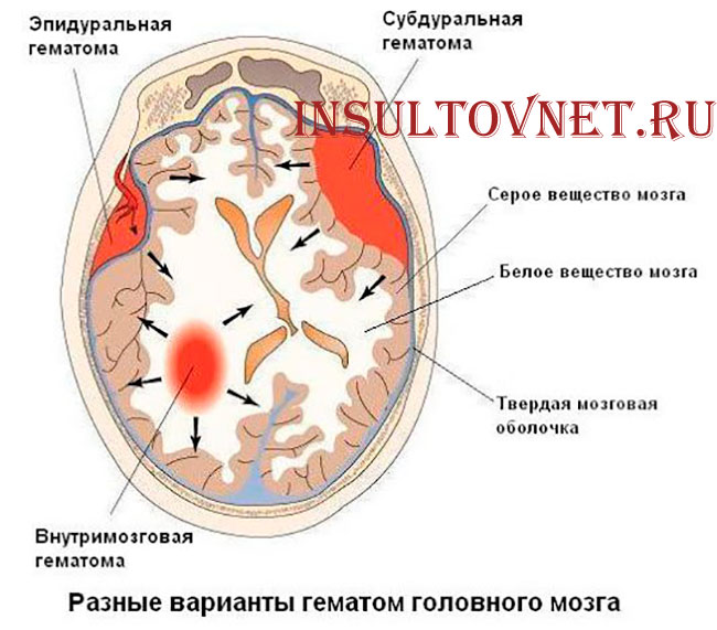 виды гематом