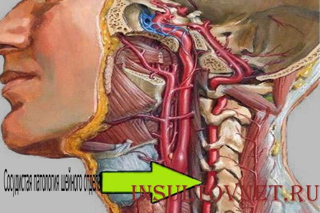 Сосудистая патология шейного отдела