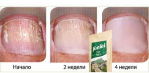 Эффект пластыря Junlei от грибка