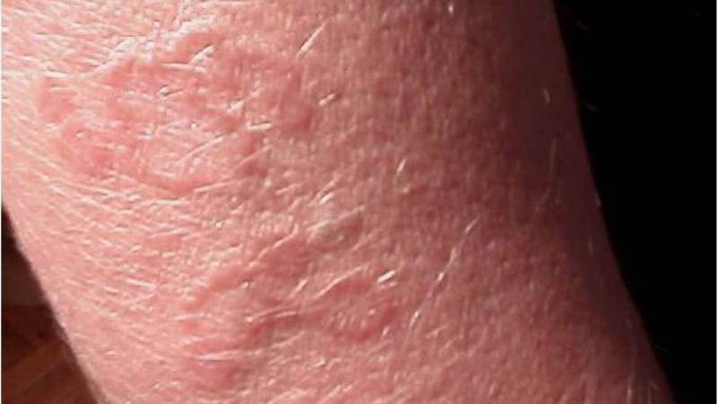 Токсокароз кожи