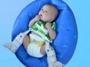 Ребёнок с подвывихом тазобедренного сустава Подвывих тазобедренного сустава у младенца