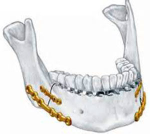 Пример шинирования нижней челюсти Остеосинтез костей челюсти