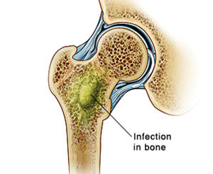 Кость в разрезе Остеомиелит после перелома