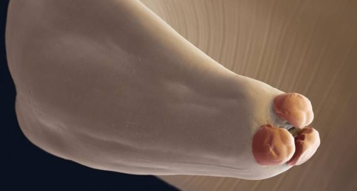 Аскаридозе