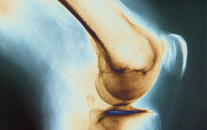 Кость Костный туберкулез