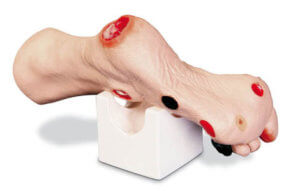 Пролежень на начальных стадиях на ноге