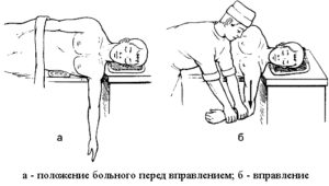 Схема вправления вывиха плеча по методу Джанелидзе Схема метод Джанелидзе