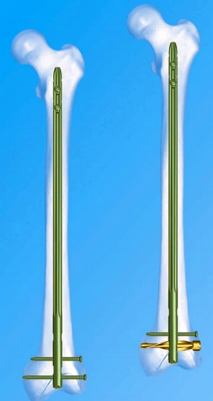 Штифт ЦИТО Ретроградный интрамедуллярный остеосинтез