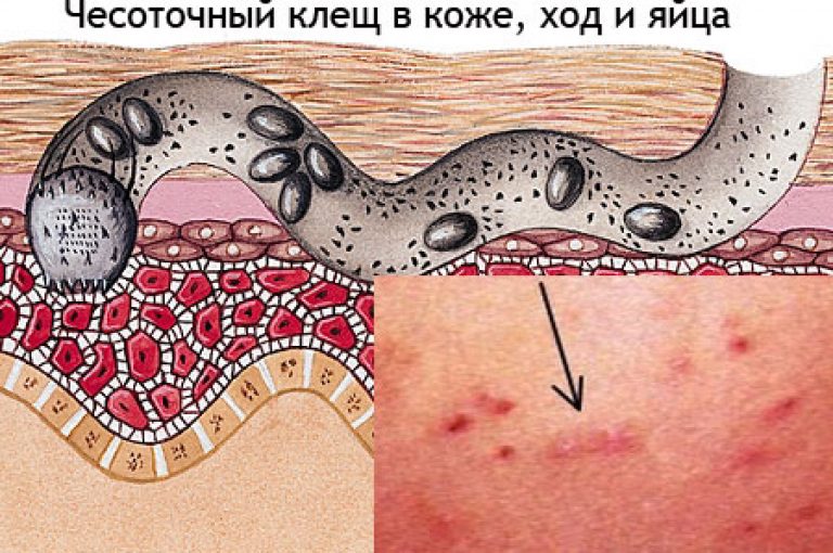 Чесоточные ходы под кожей