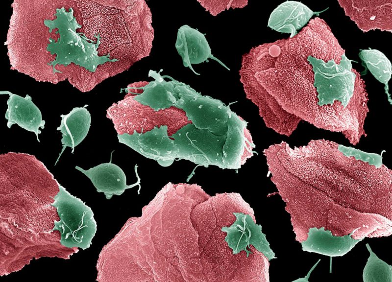 Трихомониаз