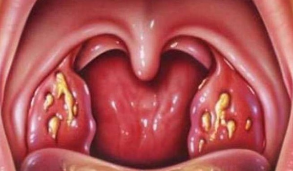 гнойная ангина