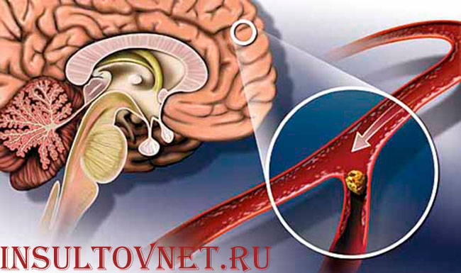 сосуды мозга