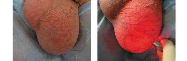 увеличение в размерах мошонки