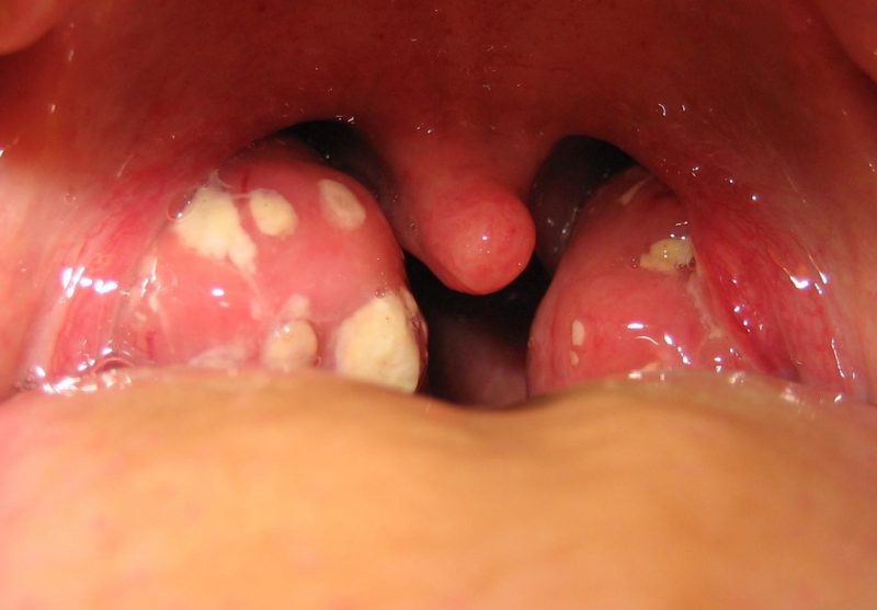 гной в горле