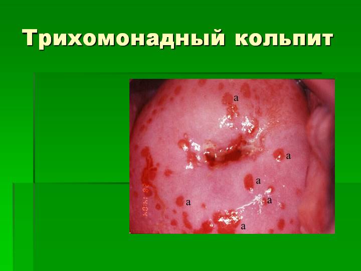 трихомонадный кольпит