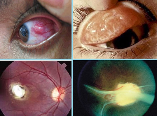 Глазной токсокароз