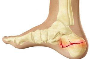 Стопа Перелом пятки