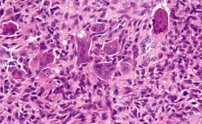 Эхинококк альвеолярный