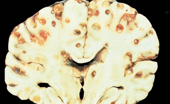 эхинококкоз