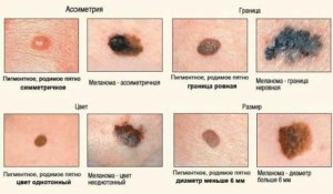 Рак кожи признаки