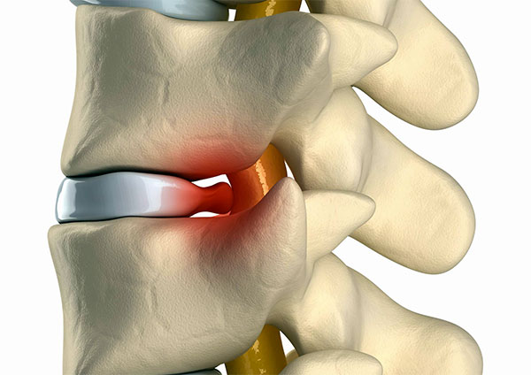 Вовремя выявленная грыжа позвоночника имеет больше шансов на лечение