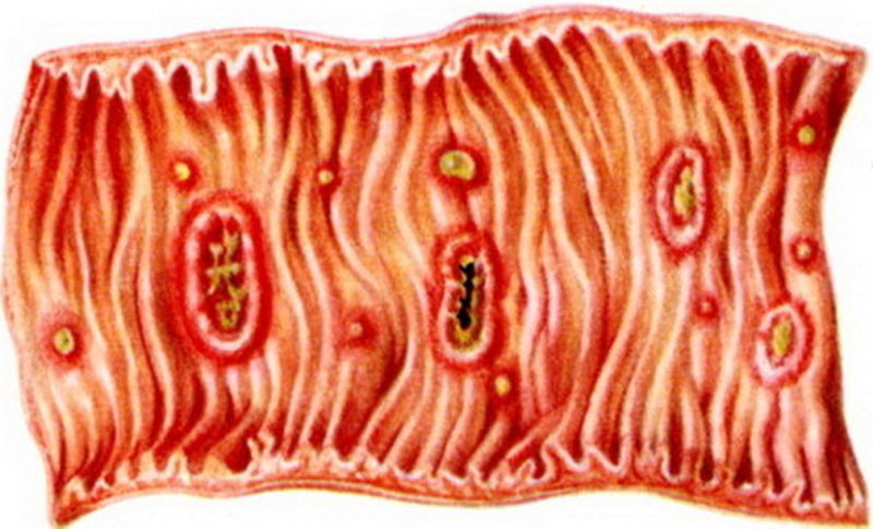 Инвазивная форма