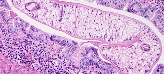 Симптомы описторхоза