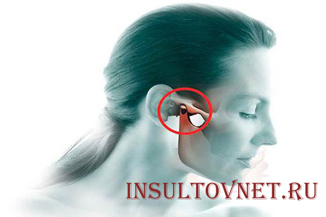 Синдром костена