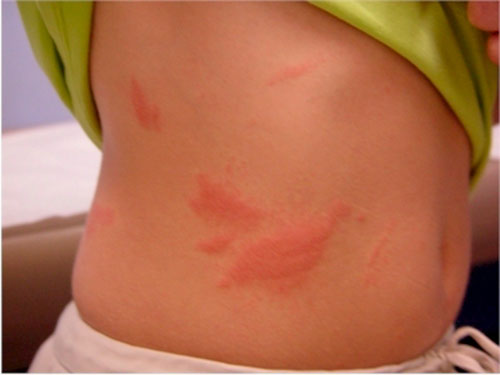 Сыпь при гельминтозах — причины, виды, лечение