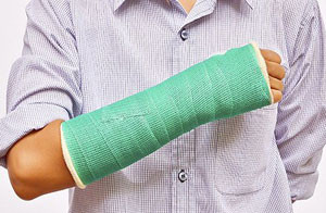 Гипс на руке Гипсовая повязка