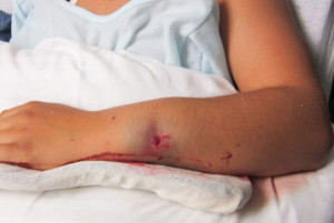 Отек при переломе Симптомы перелома предплечья