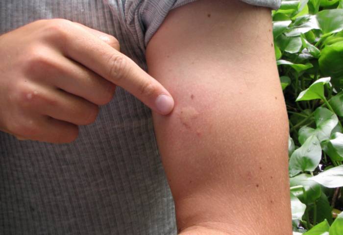 дирофиляриоза подкожный