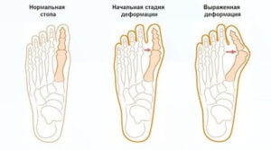 Как выглядит деформация косточки на пальце ноги