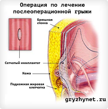Современные методы лечения послеоперационных грыж всех видов