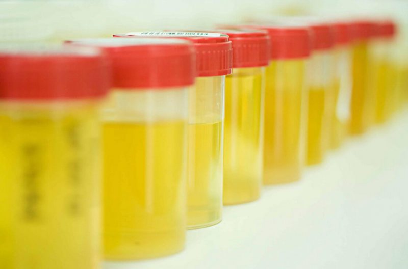 анализ мочи