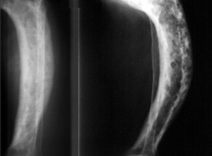 Рентген костей Пятнистый остеопороз