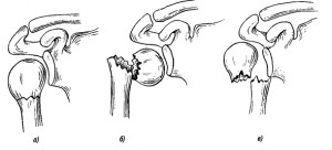 Перелом шейки плеча Переломы хирургической шейки плеча