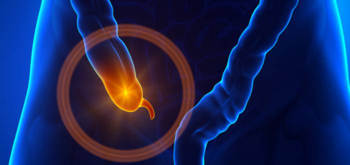 аппендицит