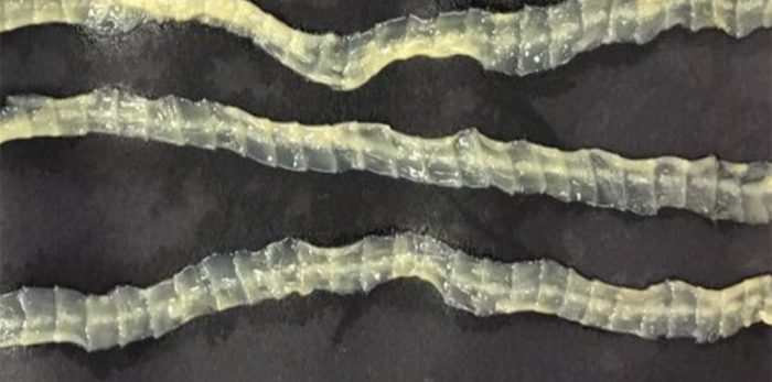 Какие симптомы вызывает дифиллоботриоз