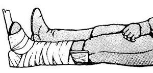 Шина на голеностоп При закрытом переломе необходимо наложить шину