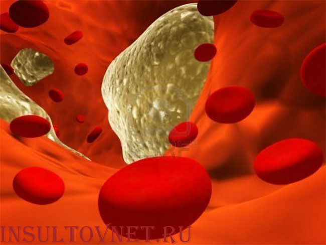 атеросклероз