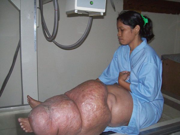 диагностика слоновой болезни