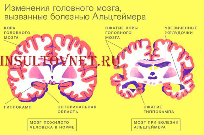 изменения мозга