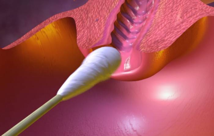 соскоб на хламидии