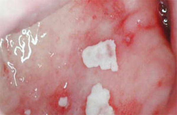 молочница фото