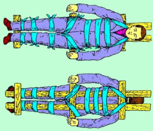 иммобилизация пострадавшего Для иммобилизации пострадавшего, нужно закрепить положение человека на твердой поверхности