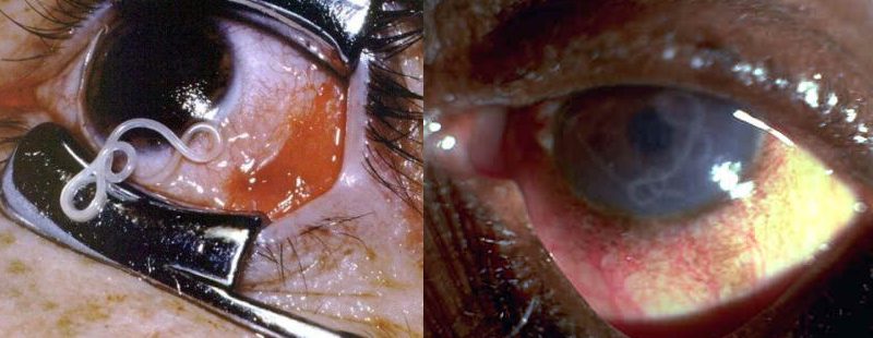 крысиный легочный червь