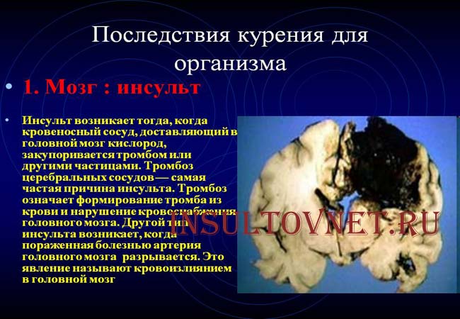 Курение и инсульт